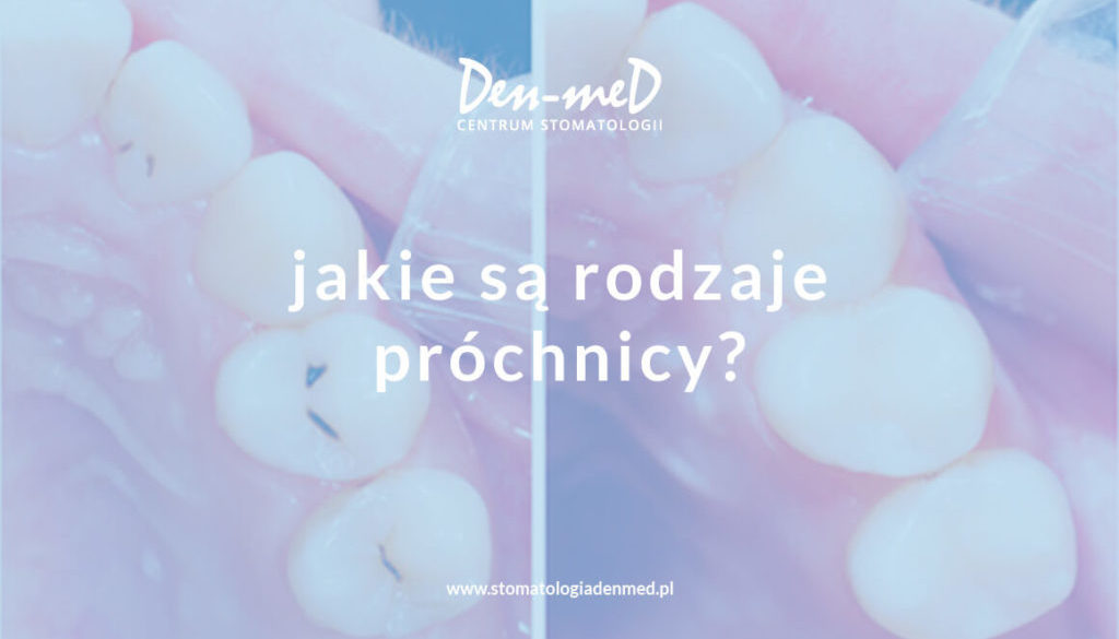 jakie są rodzaje próchnicy?