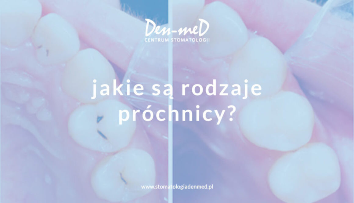 jakie są rodzaje próchnicy?