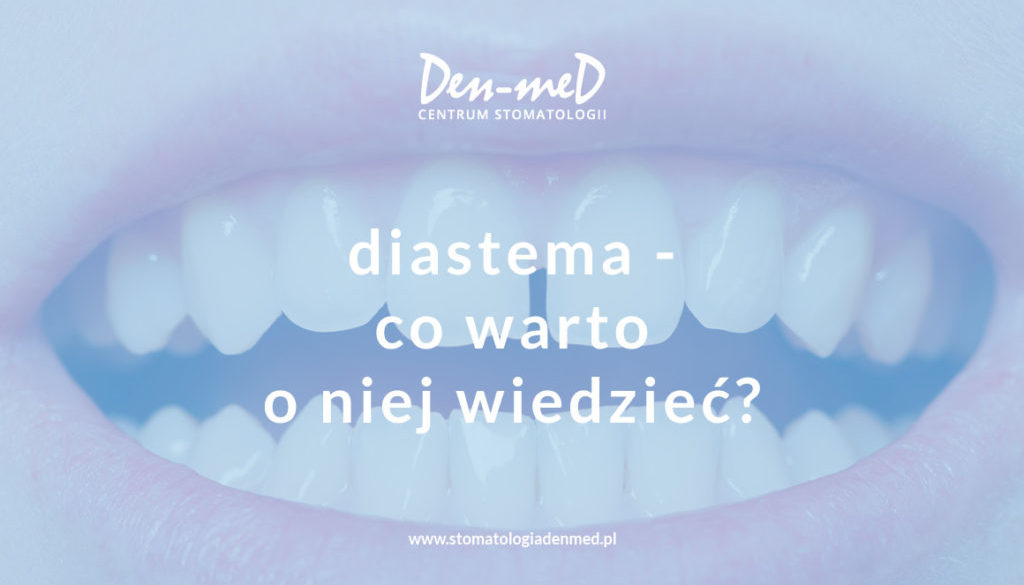 diastema - co warto o niej wiedzieć
