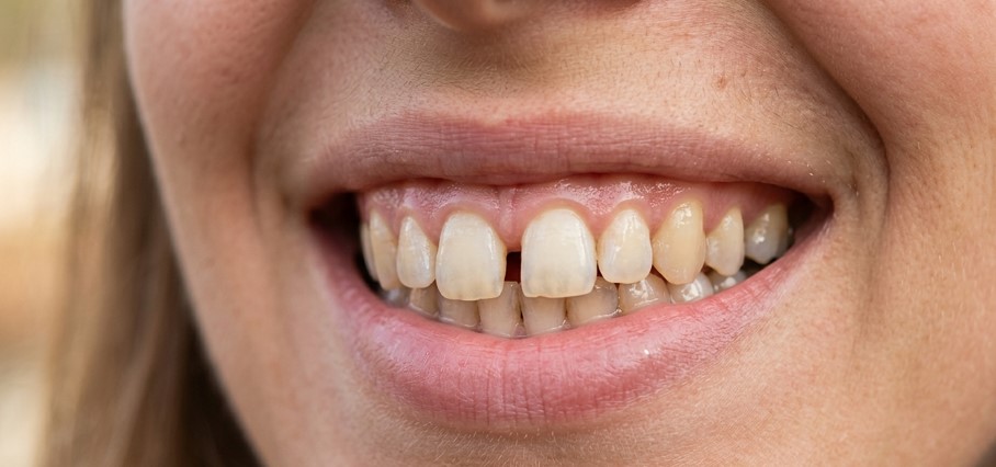 Diastema między górnymi jedynkami - zbliżenie uśmiechu kobiety z widoczną przerwą między przednimi zębami