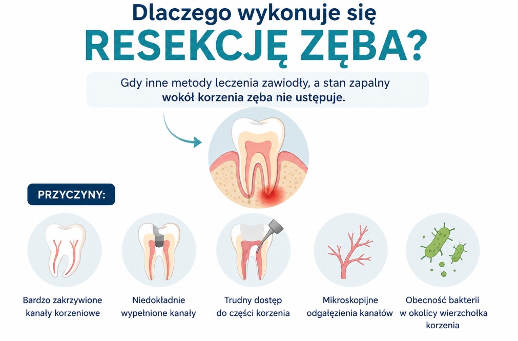 Dlaczego wykonuje się resekcję zęba?