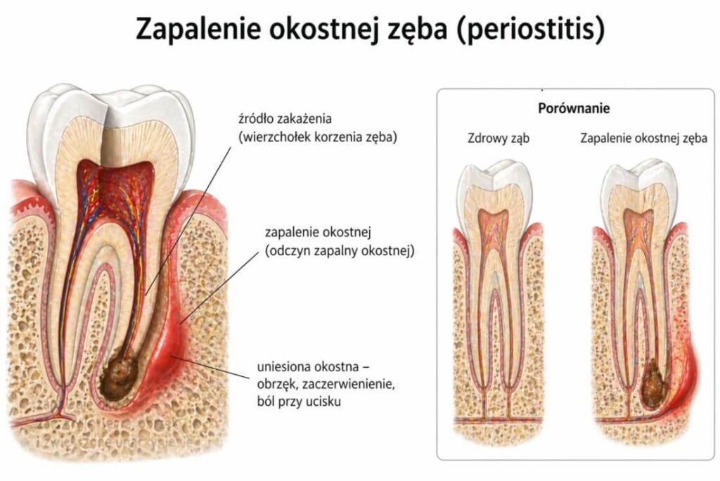 Zapalenie okostnej zęba - schemat przekroju zęba z widocznym stanem zapalnym przy wierzchołku korzenia, obrzękiem i zaczerwienieniem okostnej oraz ogniskiem infekcji; porównanie zdrowego zęba i zmienionego chorobowo w ilustracji medycznej