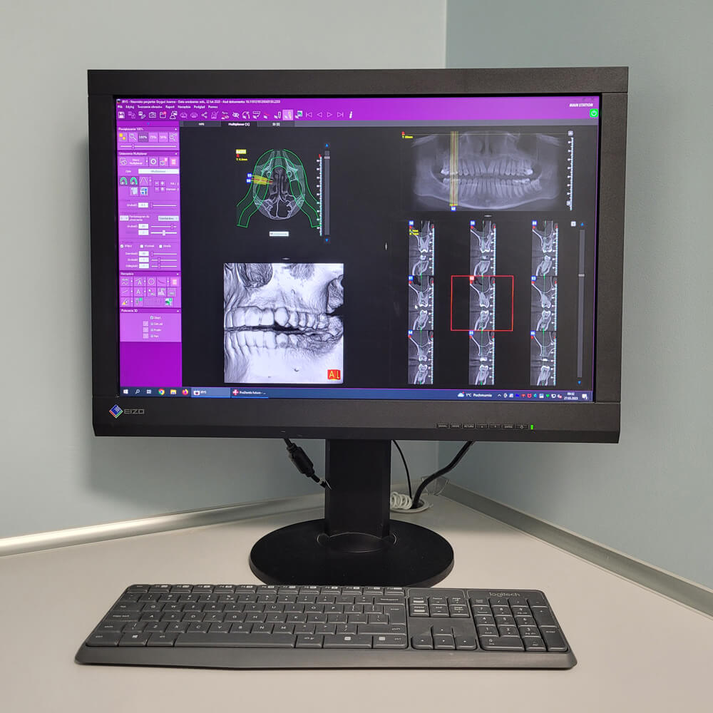 tomografia-komputerowa-zebow-denmed automatyczny system czyszczenia