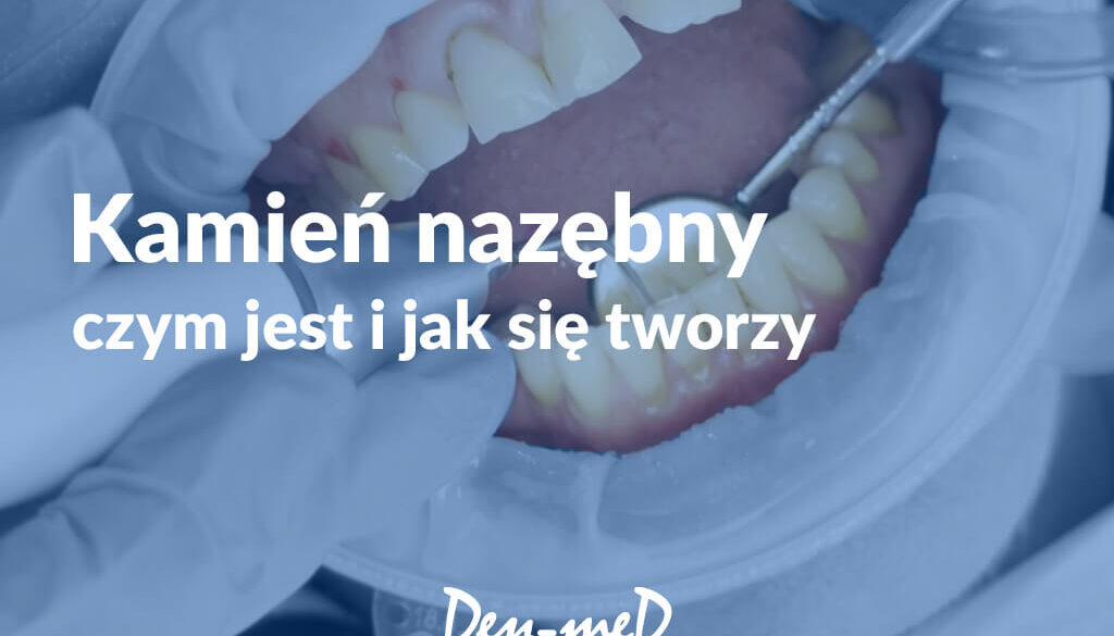 Kamień nazębny na zębach pacjenta podczas badania stomatologicznego – czym jest i jak się tworzy